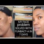 How to Use Funbact A To Clear Pimples