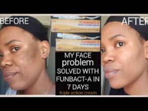 How to Use Funbact A To Clear Pimples