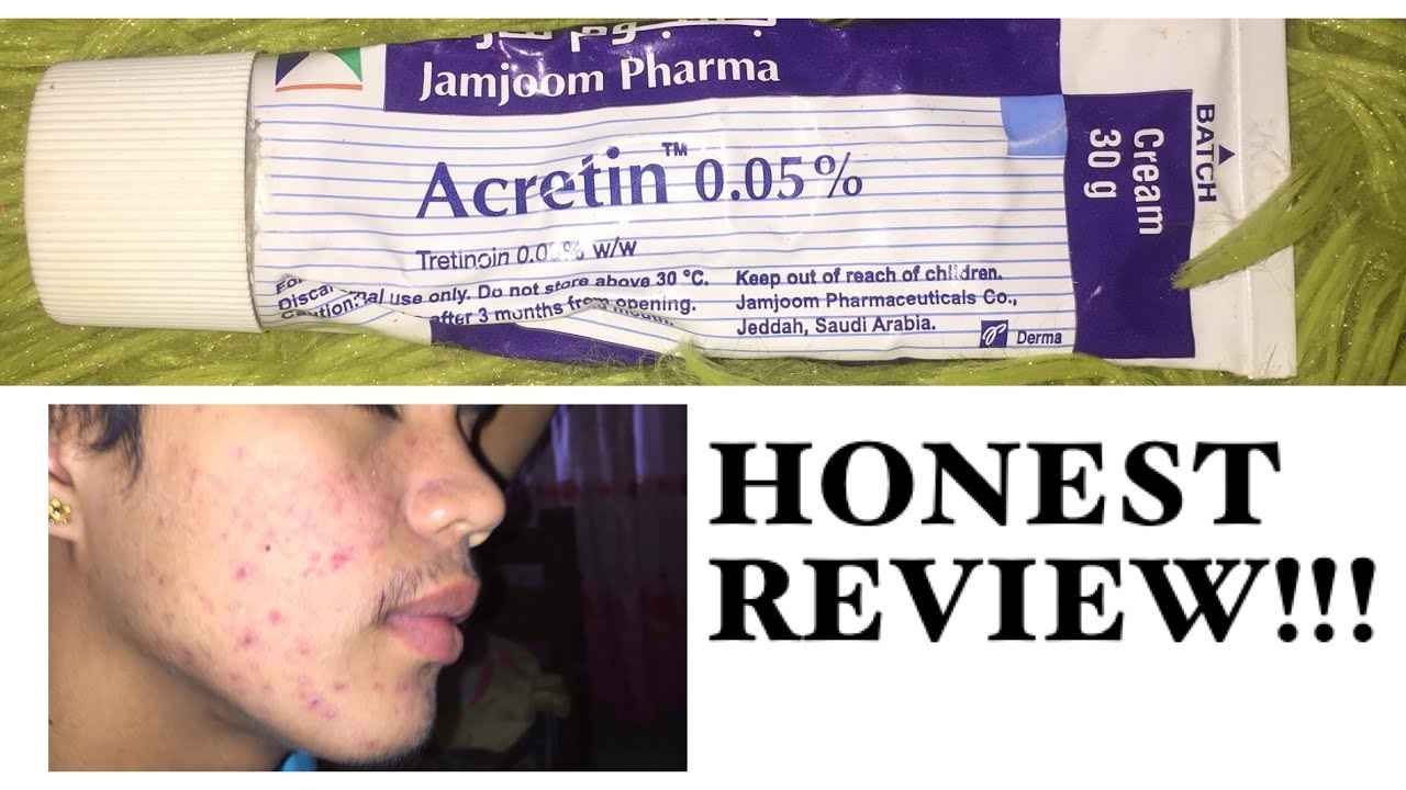 Acretin Cream Reviews